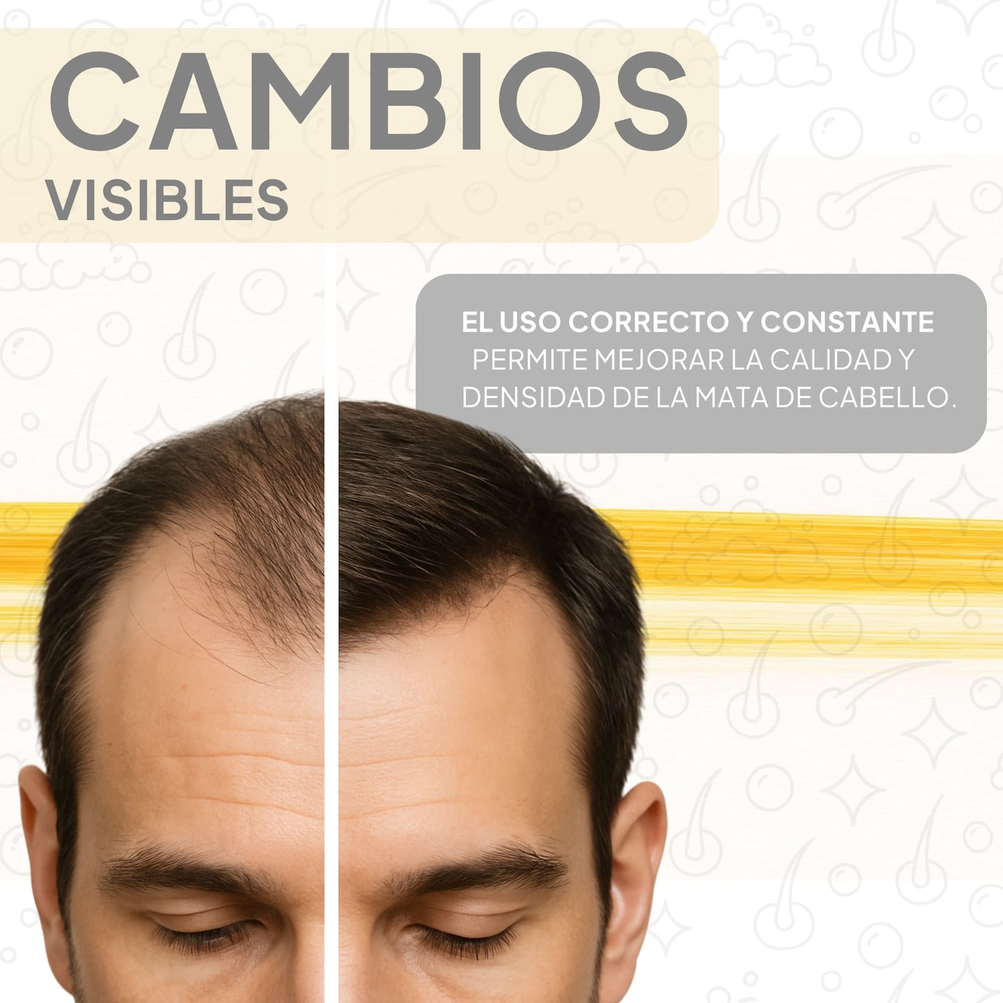 SHAMPOO CON MINOXIDIL Y COLÁGENO PARA CRECIMIENTO DE CABELLO